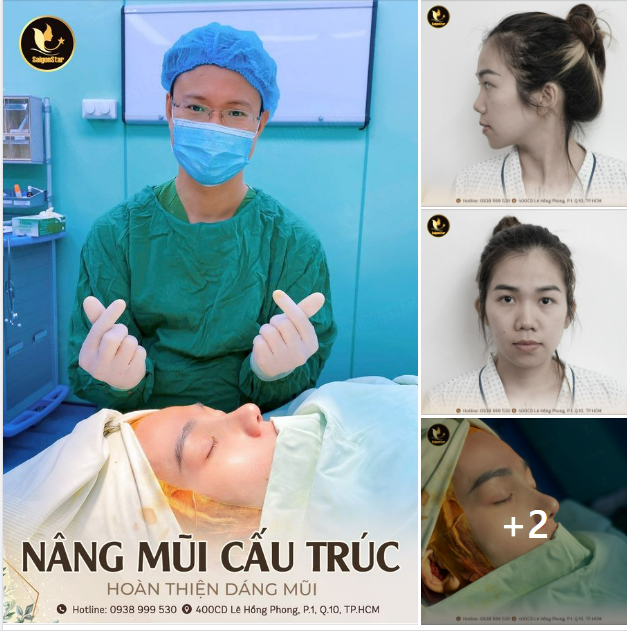 NÂNG MŨI CẤU TRÚC – HOÀN THIỆN DÁNG MŨI