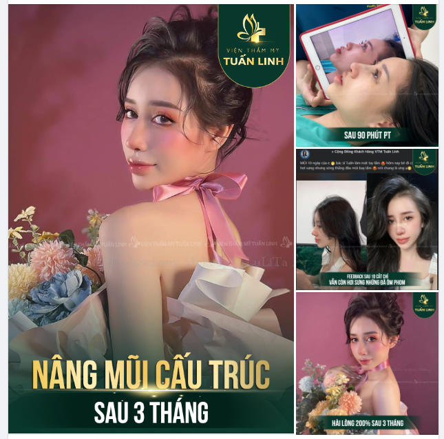 NÂNG MŨI CẤU TRÚC KẾT QUẢ SAU 3 THÁNG