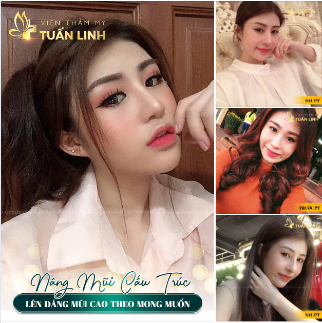 NÂNG MŨI CẤU TRÚC - LÊN DÁNG MŨI CAO THEO MONG MUỐN