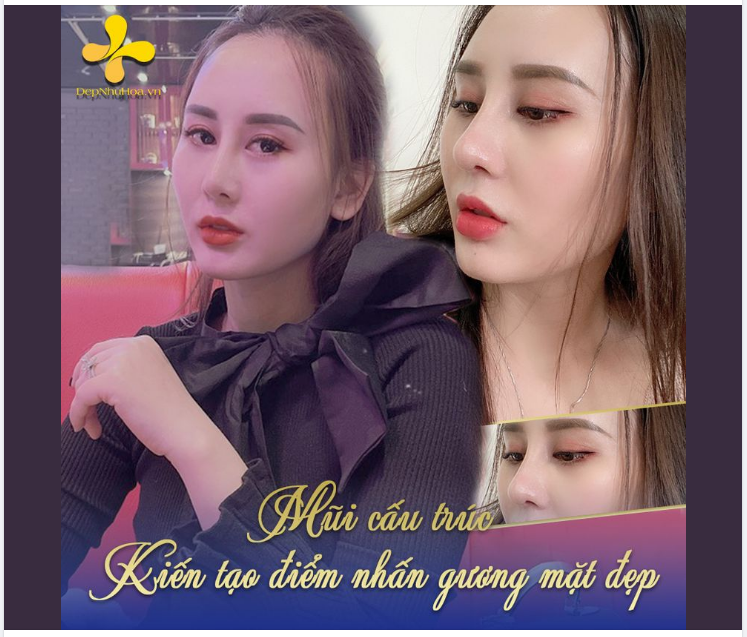 NÂNG MŨI CẤU TRÚC - Lựa chọn tuyệt vời để loại bỏ chiếc mũi nhiều khuyết điểm như thấp, tẹt; đầu mũi to, cánh mũi bè, sống mũi gồ,...