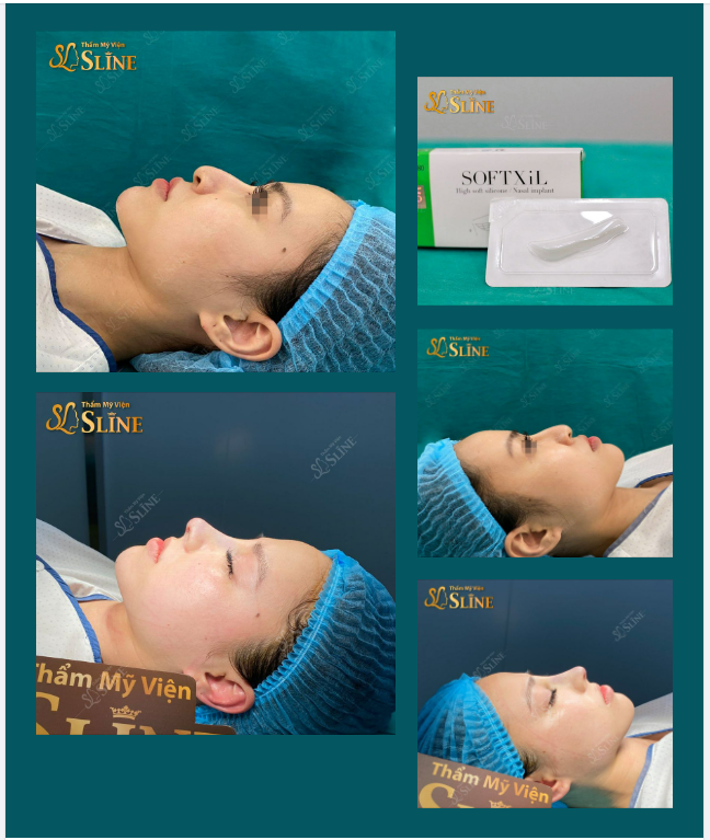 NÂNG MŨI CẤU TRÚC SOFTXIL  BÍ QUYẾT CHO DÁNG MŨI CHUẨN TỶ LỆ VÀNG