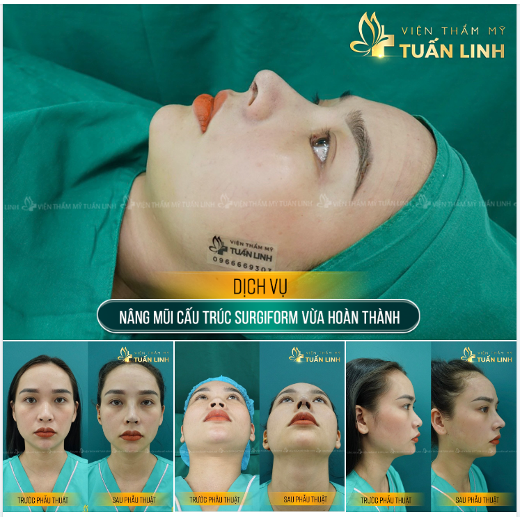 NÂNG MŨI CẤU TRÚC SURGIFORM - KẾT QUẢ SAU 90 PHÚT