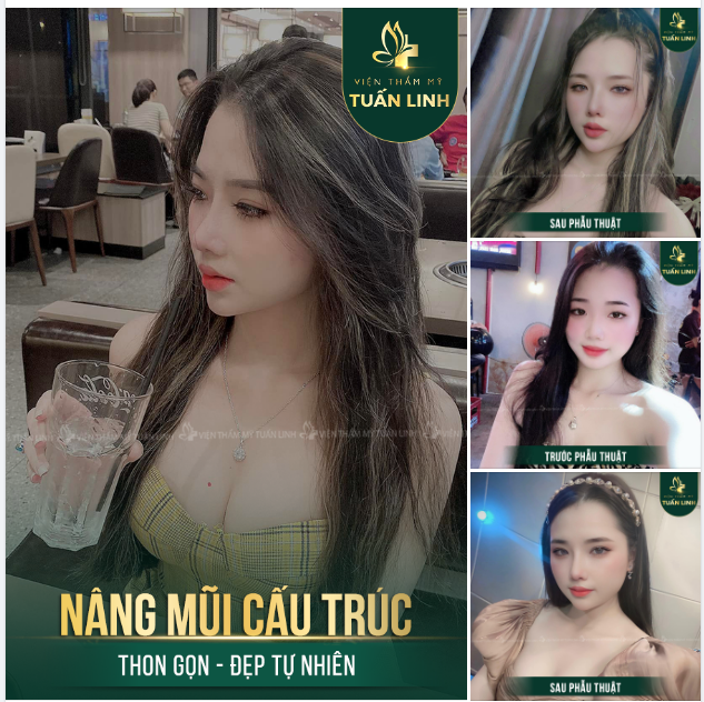 NÂNG MŨI CẤU TRÚC - THON GỌN - ĐẸP TỰ NHIÊN - HỢP PHONG THUỶ