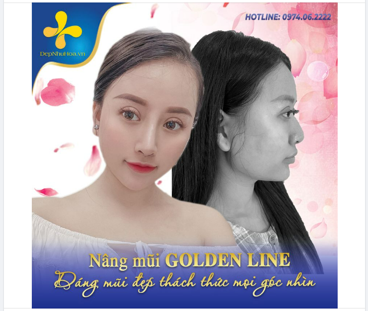 NÂNG MŨI GOLDEN LINE - PHƯƠNG PHÁP CHỈNH SỬA DÁNG MŨI HOÀN HẢO