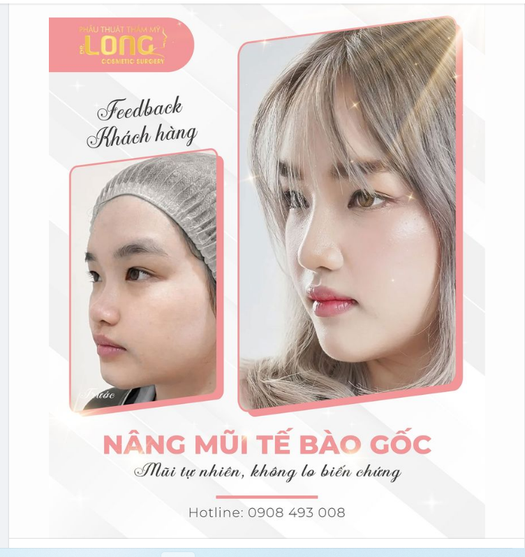NÂNG MŨI KHÔNG ĐAU KHÔNG PHẪU THUẬT
