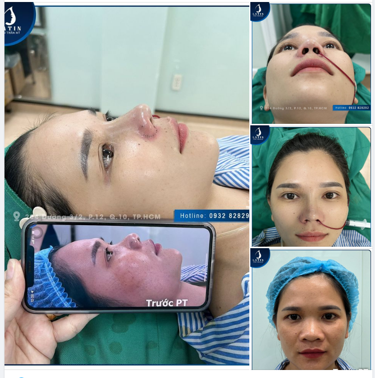 Nâng mũi nhẹ nhàng KHÔNG HỀ SƯNG ĐAU