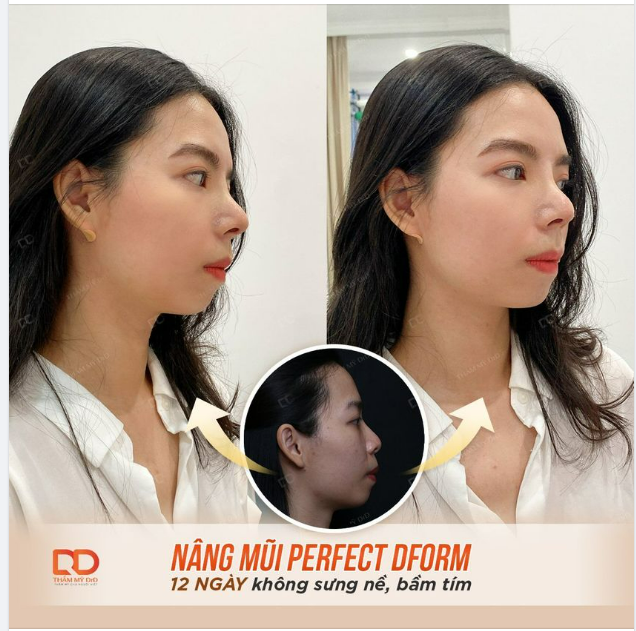 NÂNG MŨI PERFECT DFORM 12 NGÀY KHÔNG BẦM TÍM.