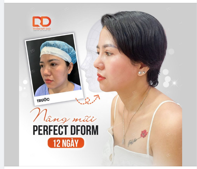 NÂNG MŨI PERFECT DFORM CHUẨN FORM DÁNG, CHUẨN AN TOÀN