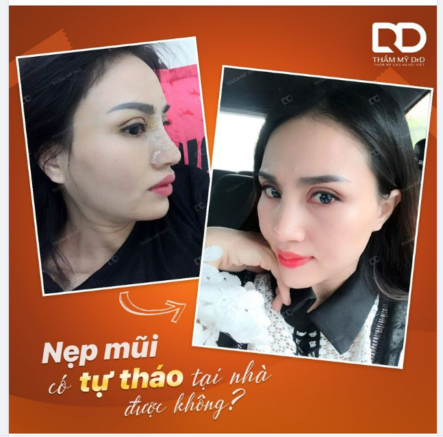 NÂNG MŨI PERFECT DFORM CÓ ĐƯỢC TỰ THÁO NẸP Ở NHÀ KHÔNG