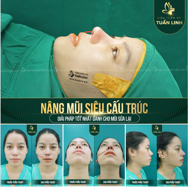 NÂNG MŨI SIÊU CẤU TRÚC - ĐỈNH CAO TRONG TẠO HÌNH MŨI SỬA LẠI.