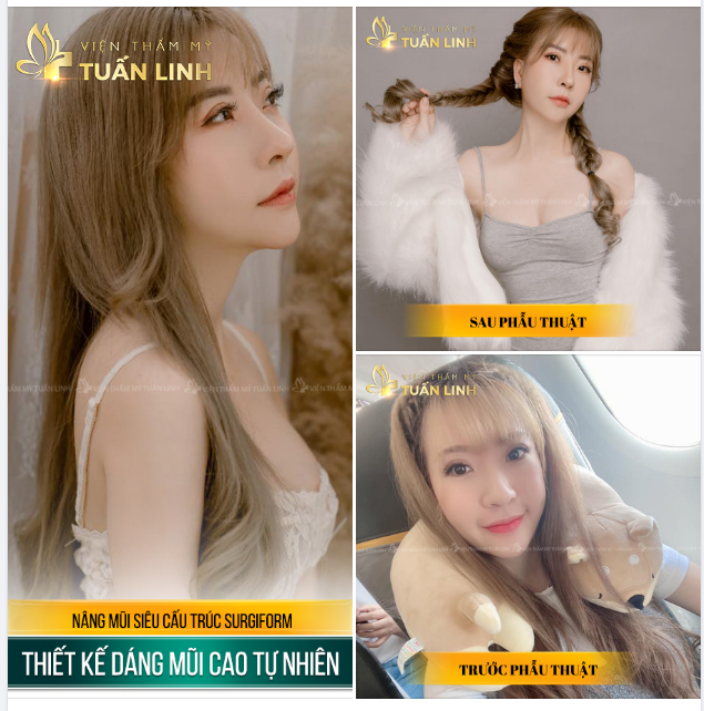 NÂNG MŨI SIÊU CẤU TRÚC SURGIFORM - PHƯƠNG PHÁP NÂNG MŨI TỐT NHẤT HIỆN NAY.