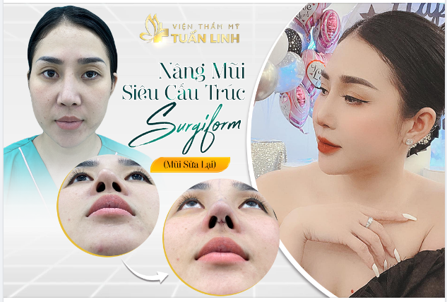 NÂNG MŨI SIÊU CẤU TRÚC SURGIFORM
