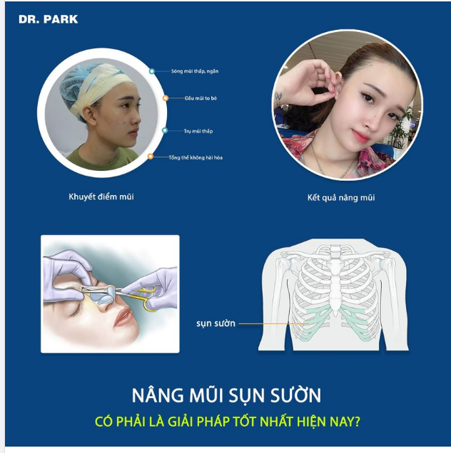 NÂNG MŨI SỤN SƯỜN, GIẢI PHÁP NÂNG MŨI TỐT NHẤT HIỆN NAY