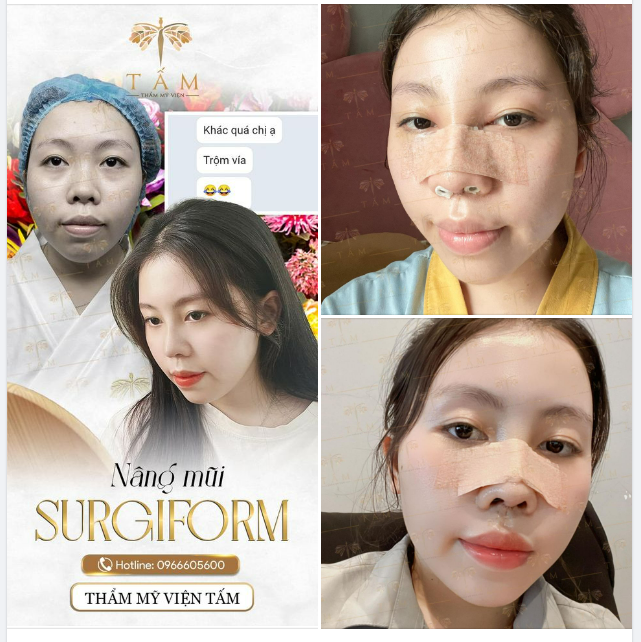 Nâng mũi Surgiform đã biến đổi nhan sắc khách hàng thế nào