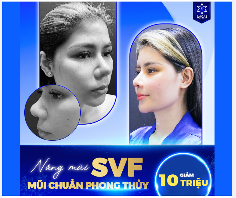 NÂNG MŨI SVF - MŨI CHUẨN PHONG THỦY - BỀN ĐẸP THEO THỜI GIAN