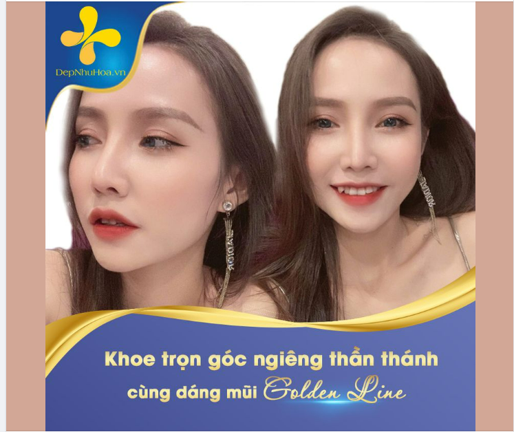 Nâng mũi xong diện mạo thần thái, cao sang hơn hẳn ạ
