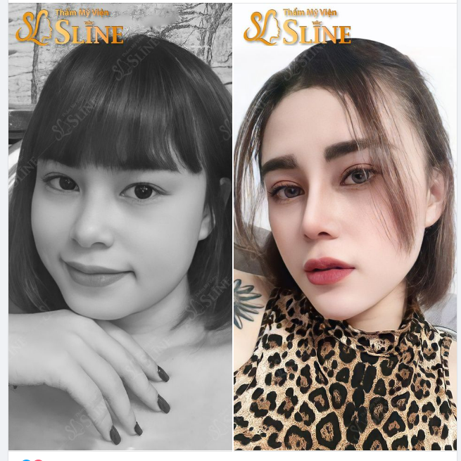 NÂNG MŨI....Sẽ giúp khuôn mặt bạn trở nên cân đối và sang chảnh hơn.