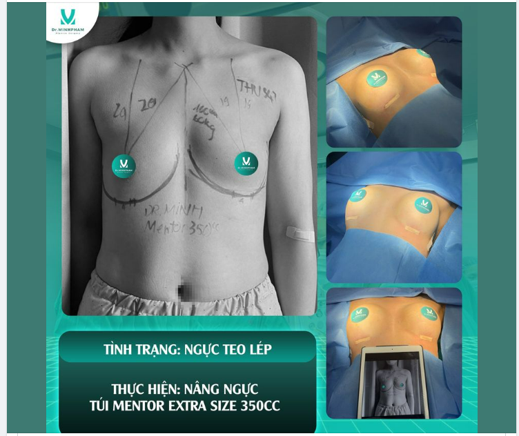 NÂNG NGỰC ĐẶT TÚI
