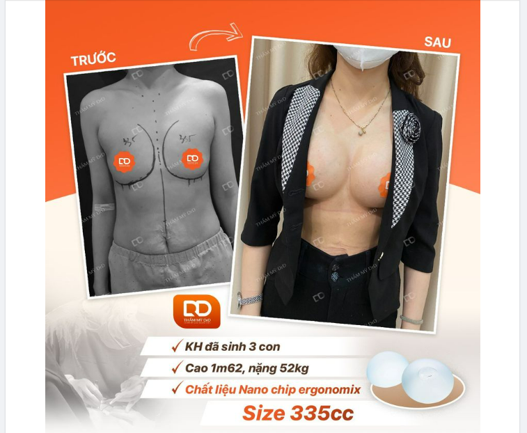 NÂNG NGỰC SIZE BAO NHIÊU THÌ CHUẨN ĐẸP, TẠO KHE SÂU KHÍT
