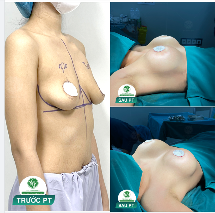 NÂNG NGỰC TREO THU QU.ẦNG CHO KHÁCH HÀNG 25 TUỔI