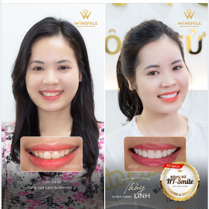 NÂNG TẦM NHAN SẮC, THĂNG HẠNG NỤ CƯỜI CÙNG RĂNG SỨ HT-SMILE 