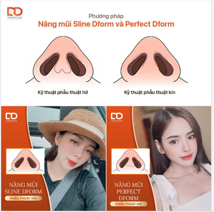 NÊN LỰA CHỌN NÂNG MŨI SLINE DFORM HAY PERFECT DFORM