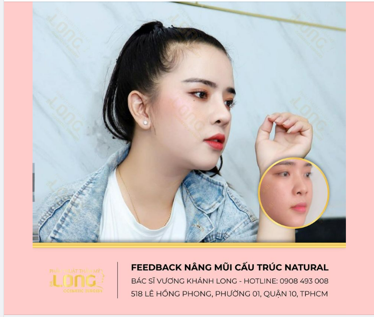 NGẮM NHÌN DÁNG MŨI CỦA NÀNG KHÁCH SAU 1 THỜI GIAN NÂNG MŨI