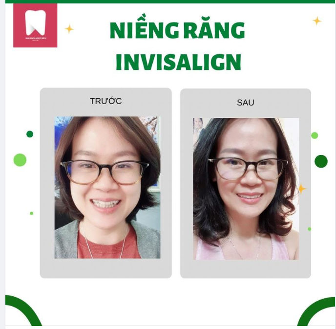 NGOÀI 30 TUỔI CÓ THỂ NIỀNG RĂNG NỮA KHÔNG
