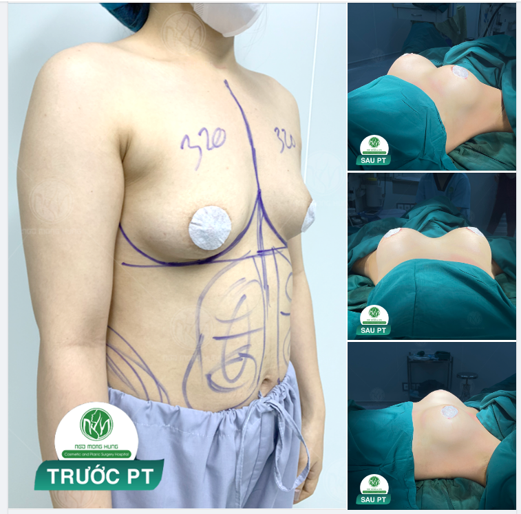 NGỰC 320cc ĐẸP NGAY SAU HOÀN THÀNH