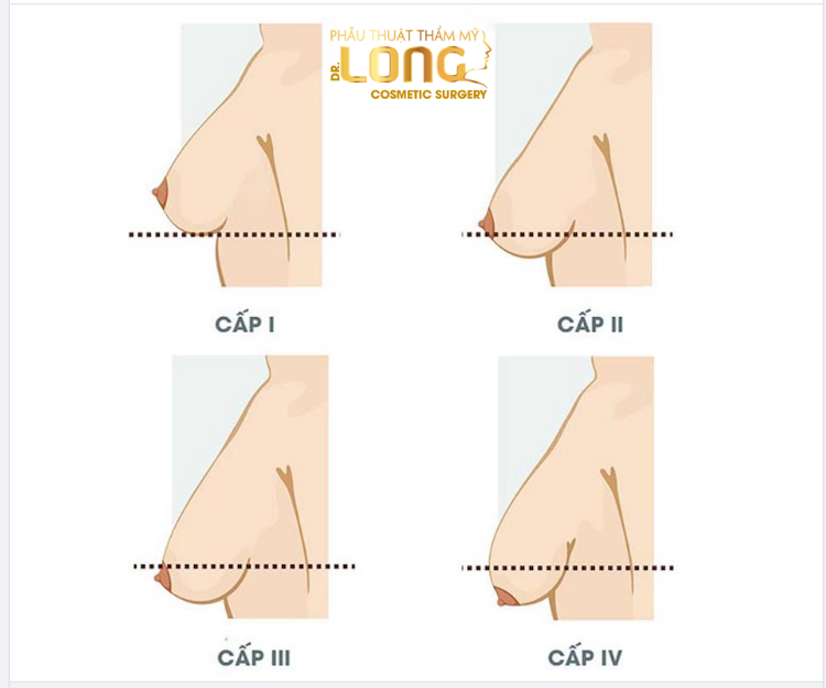 Ngực của bạn đang chảy xệ ở cấp độ mấy