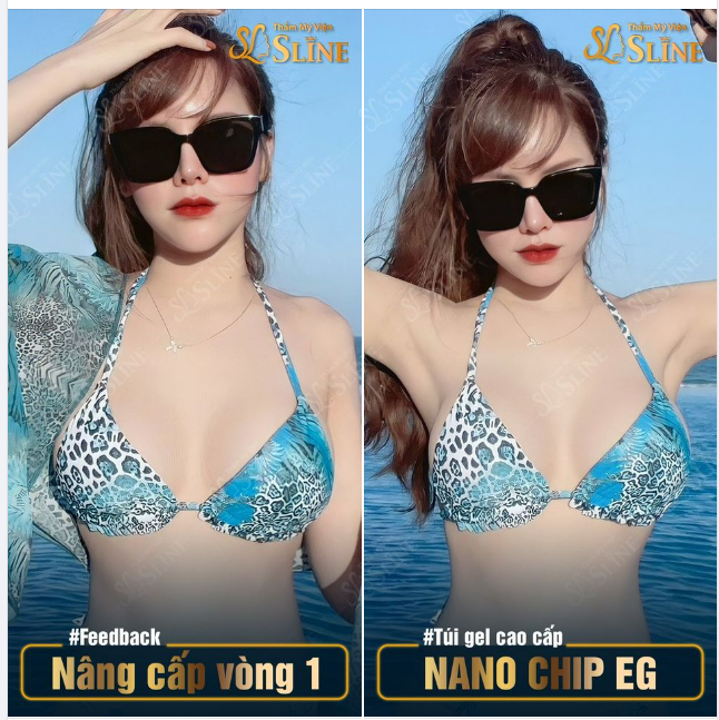 NGỰC ĐẸP Chỉ với 53,9tr - Áp dụng trong tháng này