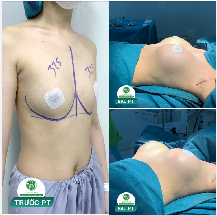 NGỰC ĐẸP TỰ NHIÊN SAU 60 PHÚT THỰC HIỆN