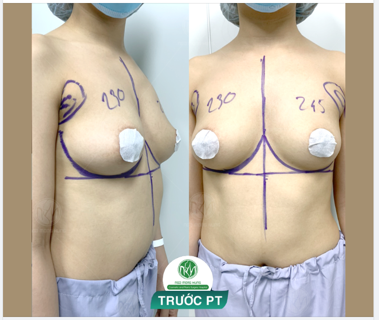 NGỰC NỘI SOI ĐẶT TÚI 230 - 245CC CHO KH CÓ VÒNG 1 KHÔNG ĐỀU