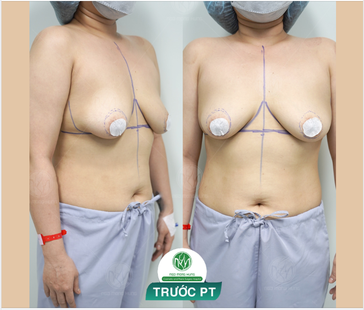 NGỰC SA TRỄ - KHẮC PHỤC NHƯ THẾ NÀO
