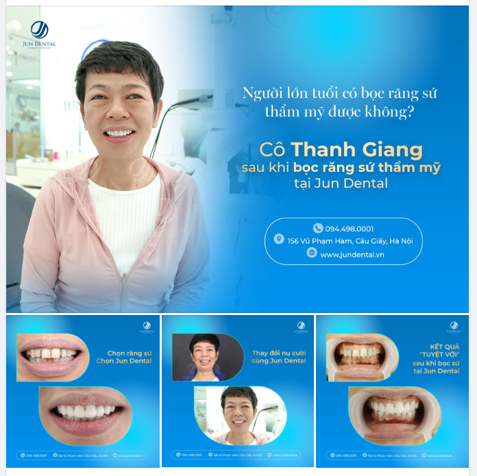NGƯỜI LỚN TUỔI CÓ BỌC RĂNG SỨ THẨM MỸ ĐƯỢC KHÔNG?