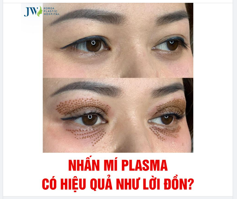 NHẤN MÍ PLASMA CÓ HIỆU QUẢ NHƯ LỜI ĐỒN