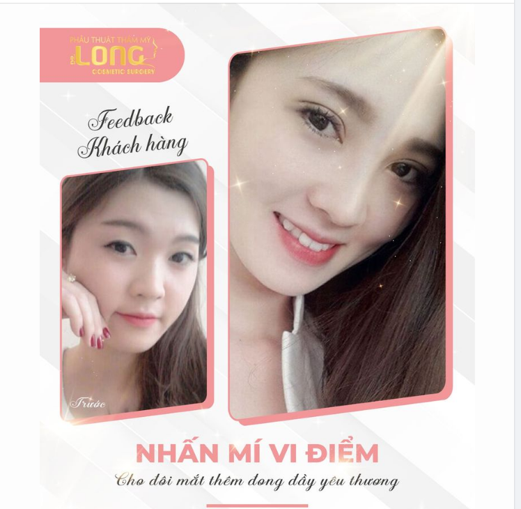 NHẤN MÍ VI ĐIỂM - MÍ CHUẨN TỪNG LI, MẮT ĐẸP NHƯ Ý VỚI GIÁ ƯU ĐÃI