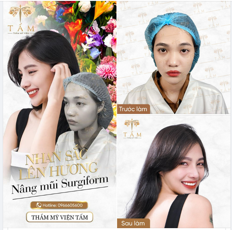 Nhan sắc lên hương với nâng mũi Surgiform
