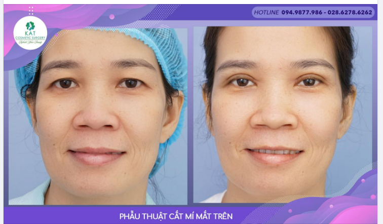 Nhiều khách hàng đến với KAT và nói rằng mắt chị lúc nào cũng trông mệt mỏi thiếu sức sống dù chị vẫn đang rất vui vẻ khoẻ mạnh. Vì sao