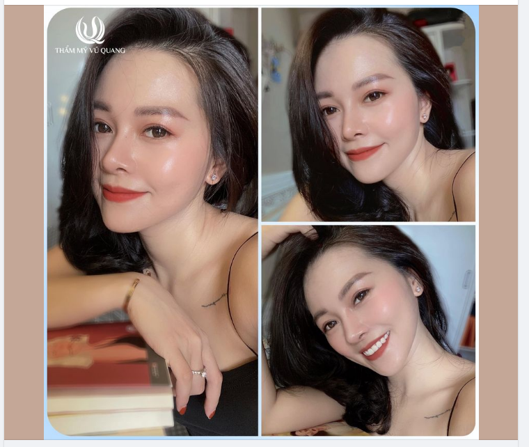 Nhiều khách hàng thắc mắc nâng mũi của Bác sĩ Vũ Quang 5 năm