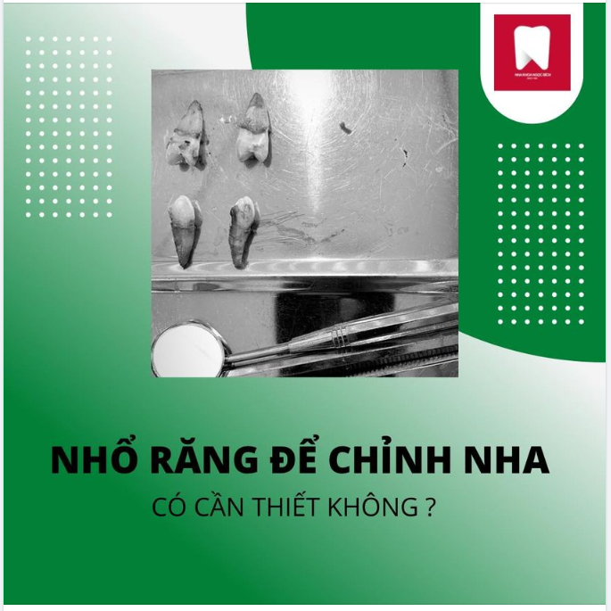 NHỔ RĂNG ĐỂ CHỈNH NHA - CÓ CẦN THIẾT KHÔNG