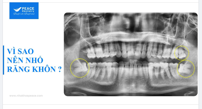 NHỔ RĂNG KHÔN LÀ BẢO VỆ SỨC KHOẺ RĂNG MIỆNG VÀ TOÀN THÂN