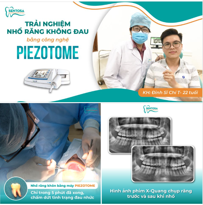 NHỔ RĂNG KHÔN NHANH CHÓNG TRONG VÒNG MỘT NỐT NHẠC VỚI PIEZOTOME