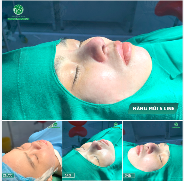 NHỮNG DÁNG MŨI ĐẸP LUÔN ĐƯỢC HOÀN THÀNH TẠI PHÒNG PHẪU THUẬT