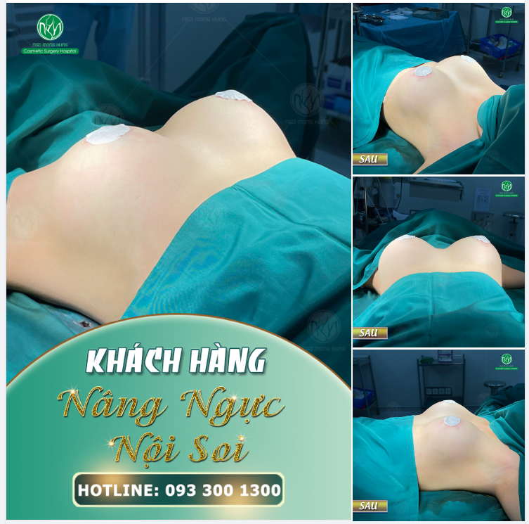 NHỮNG SUẤT ƯU ĐÃI NÂNG NGỰC CHỈ 52TRIỆU CUỐI CÙNG TẠI BV
