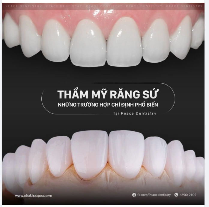NHỮNG TRƯỜNG HỢP CHỈ ĐỊNH BỌC RĂNG SỨ
