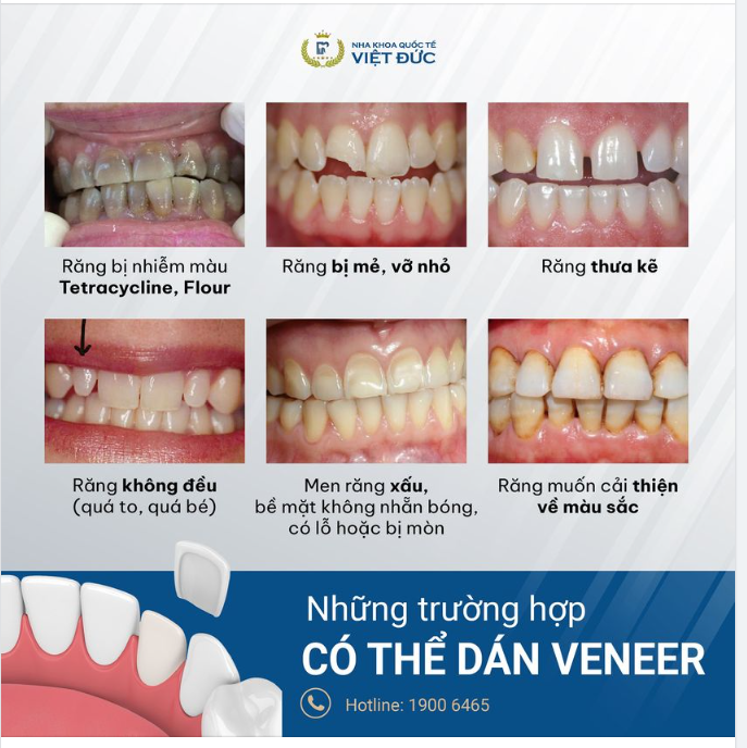 NHỮNG TRƯỜNG HỢP CÓ THỂ DÁN SỨ VENEER