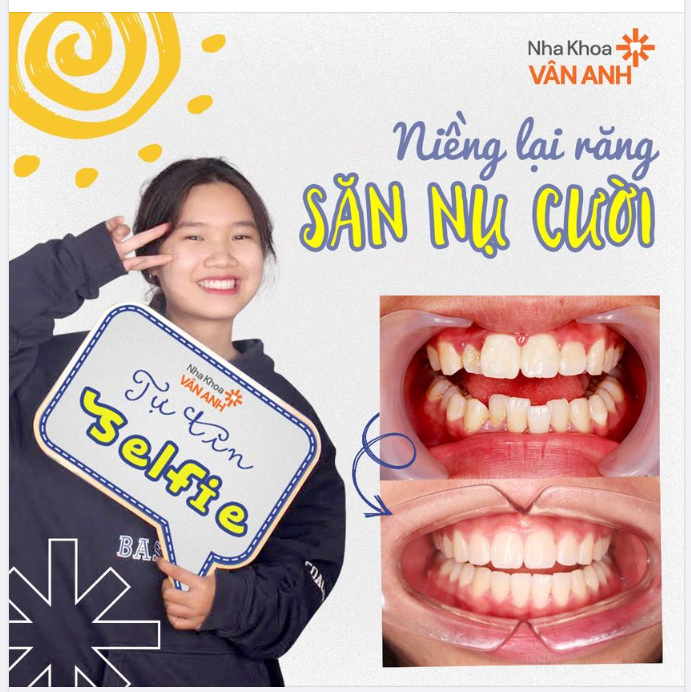 NIỀNG LẠI RĂNG - SĂN NỤ CƯỜI