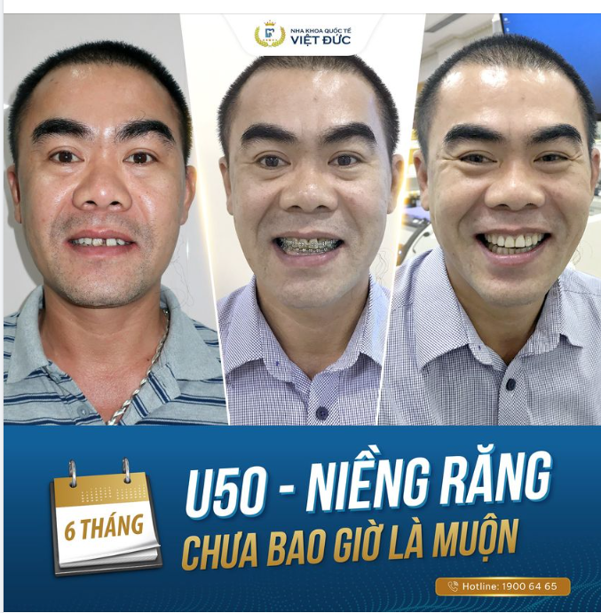 NIỀNG RĂNG CHƯA BAO GIỜ LÀ MUỘN