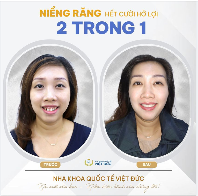 NIỀNG RĂNG CÓ HẾT CƯỜI HỞ LỢI KHÔNG?